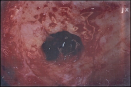 Hematoma(Intracranial)-Fig1 Kent Car Crash Lawyer