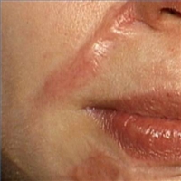 scars-200X200 Seattle auto accident lawyer