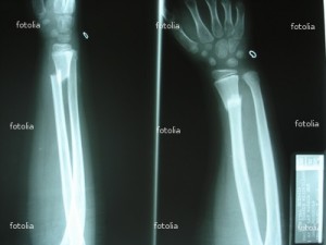 fracture car accident injury lawyer