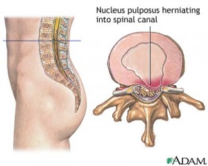 herniated disk Kent auto accident lawyer
