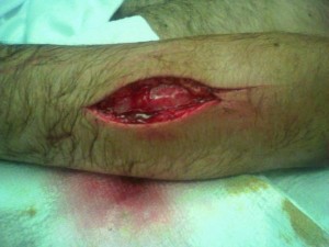 laceration Seattle motorcycle accident lawyer