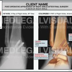 Ankle Fusion
