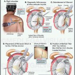 Arthroscopic Shoulder Surgery