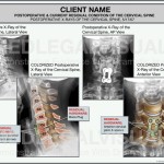 Cervical Spine Fusion