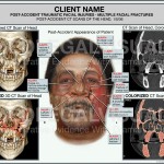 Facial Fracture Injuries Caused by Car Accident