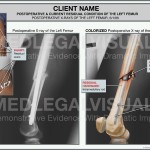 Fractured Femur Caused By Car Crash