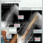 Humeral Fracture Caused by a Car Accident