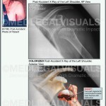 Humeral Head Fracture