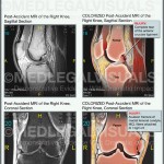 Knee Injury Caused by Car Accident