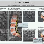 Lumbar Spine Herniation