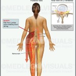 Lumbar Radiculopathy Caused by Auto Accident