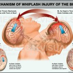 Mechanism of Whiplash Brain Injury