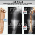 Injured Femur in Seattle Auto Accident