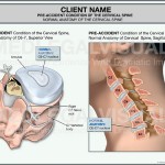 Cervical Radiculopathy Caused by a Car Crash