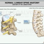 Lumbar Fusion Caused by a Car Accident