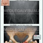 Injured Pelvis in Car Crash