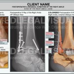 Ankle Fracture in Car Accident