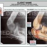 Fractured Elbow Caused by Car Crash