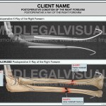 Fractured Forearm in Auto Accident