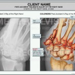 Hand Fracture Caused by Auto Accident