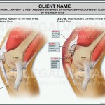 Patella Tendon Injury