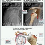 Dislocated Shoulder Caused by Car Crash
