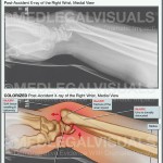 Smith Fracture Wrist Injury